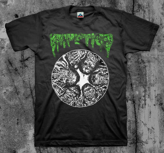 Impetigo